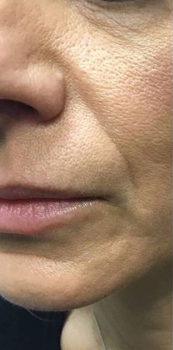 Dermal Fillers After treatment at Dexa Clinic